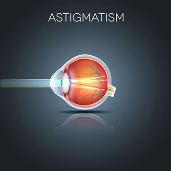 Chart Illustrating How Astigmatism Affects an Eye