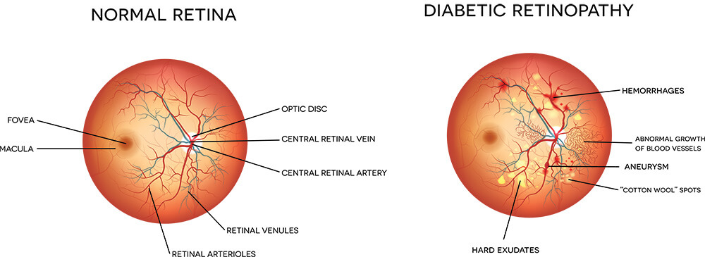 Chart Illustrating a Normal Retina Compared to One With Diabetic Retinopathy