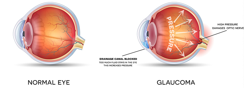 Chart Illustrating a Normal Eye Compared to One With Glaucoma