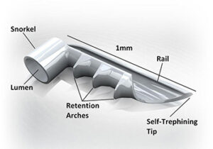 iStent Diagram