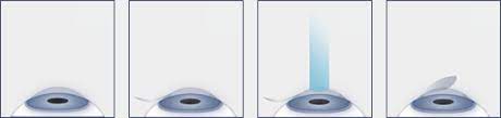 Chart Illustrating the LASIK Procedure