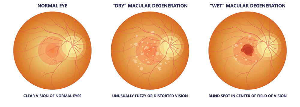 Chart Illustrating a Normal eye, compared to ones with wet and dry macular degeneration