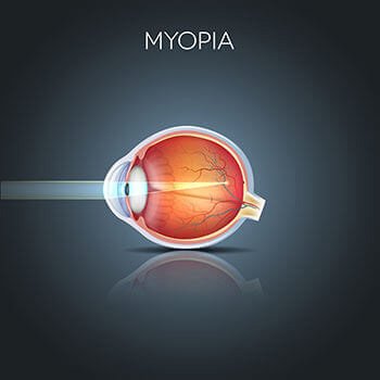 Chart Illustrating How Myopia Affects an Eye
