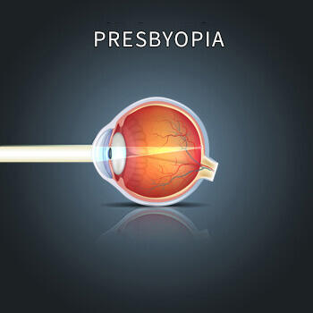 Chart Illustrating How Presbyopia Affects an Eye